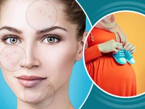 تاثیر هورمونها در بارداری روی آکنه صورت