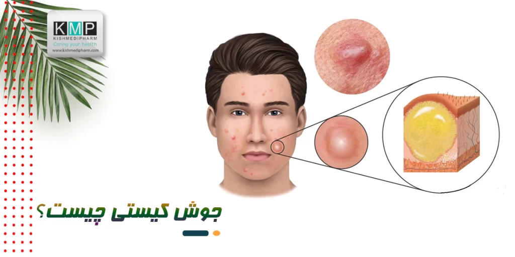 جوش کیستی چیست؟