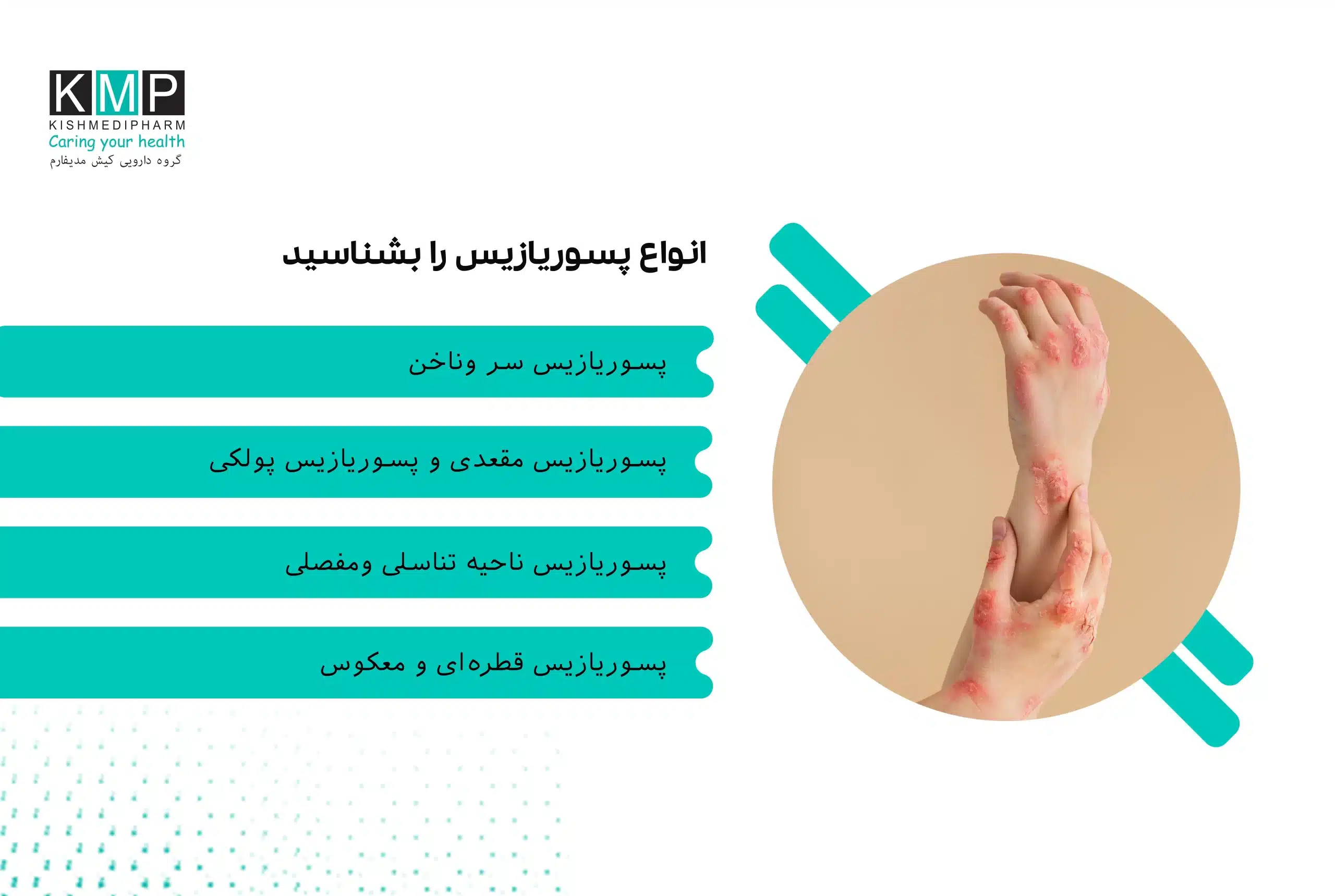 اینفوگرافیک جامع از انواع پسوریازیس شامل پسوریازیس پلاکی، سر، ناخن، مفصلی، تناسلی، معکوس، قطره‌ای، پوسچولار و اریترودرمی با نمایش نواحی درگیر بدن.