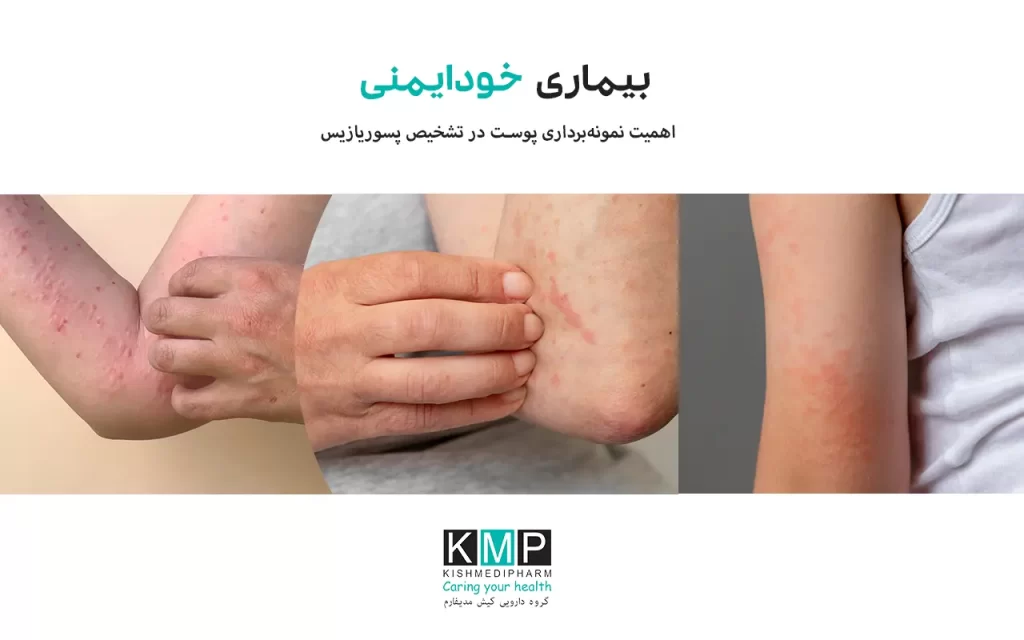 نمونه‌برداری پوست برای پسوریازیس یکی از دقیق‌ترین روش‌های تشخیصی در افتراق این بیماری مزمن خودایمنی از سایر اختلالات پوستی مشابه است. پسوریازیس به‌دلیل شباهت ظاهری با بیماری‌هایی مانند اگزما، درماتیت سبورئیک و لوپوس پوستی، همیشه تنها با معاینه بالینی قابل تشخیص قطعی نیست. در چنین شرایطی، بیوپسی پوست به‌عنوان یک روش علمی و قابل اعتماد، امکان بررسی تغییرات سلولی و ساختاری پوست را فراهم می‌کند. در این روش، پزشک متخصص با استفاده از تکنیک‌های مختلف بیوپسی، نمونه کوچکی از پوست را برداشت کرده و برای بررسی‌های میکروسکوپی به آزمایشگاه پاتولوژی ارسال می‌کند. نتایج حاصل از نمونه‌برداری می‌تواند نوع پسوریازیس، شدت التهاب و ویژگی‌های بافتی را مشخص کرده و مسیر درمانی مناسب‌تری را تعیین کند. انجام صحیح نمونه‌برداری، رعایت اصول بهداشتی و پیگیری‌های پس از آن نقش مهمی در کاهش عوارض و افزایش دقت تشخیص دارند.