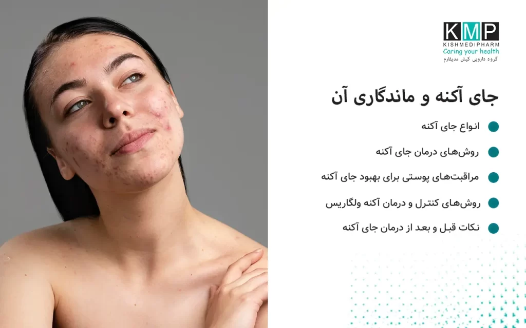 اسکار آکنه چیست و چگونه درمان می‌شود؟ اسکار آکنه جای زخم‌ها یا فرورفتگی‌هایی است که پس از بهبود جوش‌ها روی پوست باقی می‌مانند. این آثار ناشی از آسیب به لایه‌های عمیق پوست، کاهش کلاژن و التهاب طولانی هستند. روش‌های درمان جای آکنه شامل: روش‌های تخصصی: لیزر فراکشنال، میکرونیدلینگ، پیلینگ شیمیایی و تزریق PRP. داروها و کرم‌ها: رتینوئیدها، آزلائیک اسید، هیدروکینون و اسید سالیسیلیک. مراقبت‌های پوستی: استفاده از ضدآفتاب، مرطوب‌کننده، سرم‌های ویتامین C و پرهیز از دستکاری جوش‌ها. ژل آکنومیس ترکیبی از آنتی‌بیوتیک و رتینوئید است که التهاب را کاهش می‌دهد و با تحریک کلاژن، به ترمیم بافت پوست کمک می‌کند. حتی اسکارهای قدیمی و عمیق نیز با ترکیب درمان‌های تخصصی و مراقبت‌های روزانه قابل کاهش هستند.