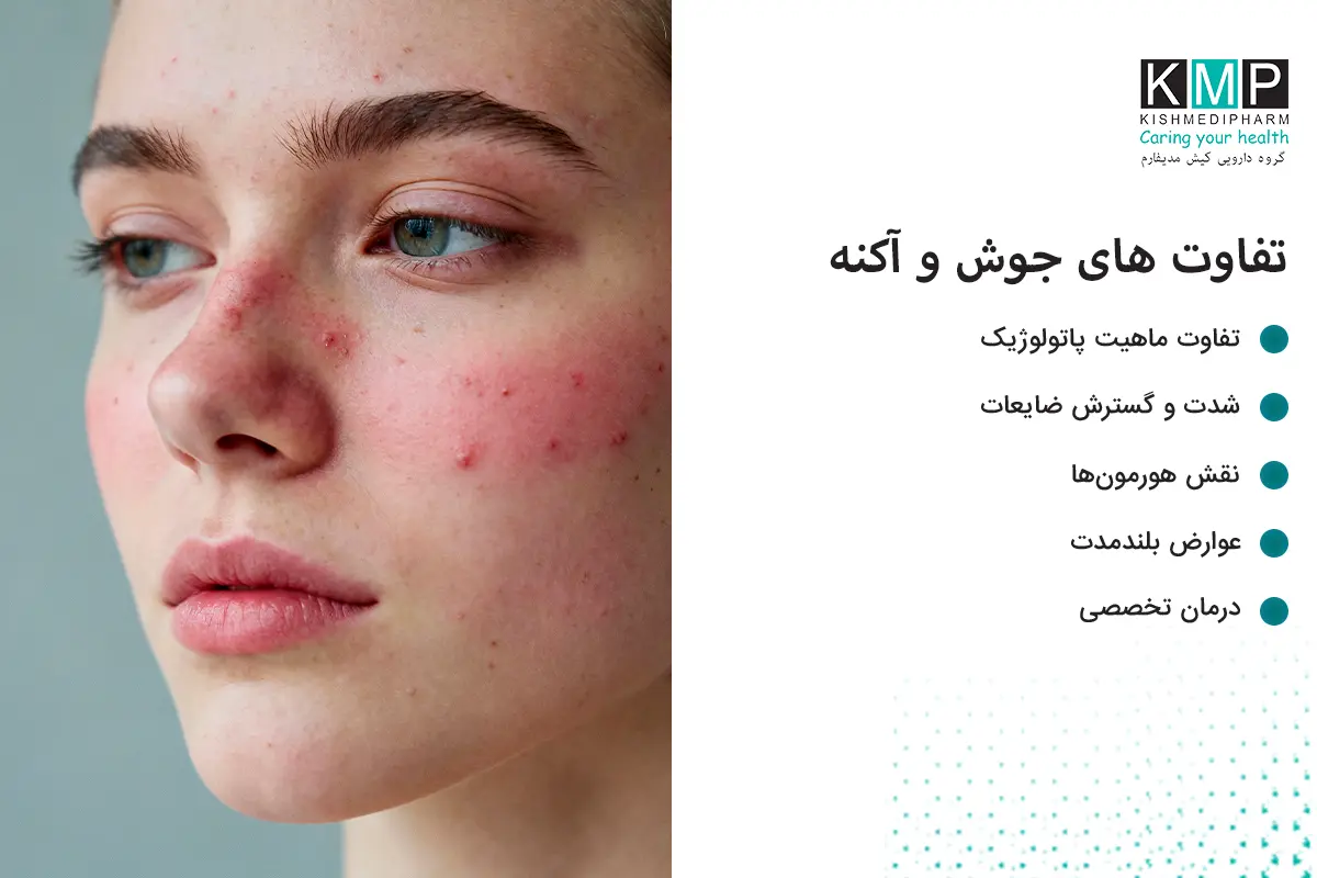 پوست یکی از مهم‌ترین ارگان‌های بدن است و هرگونه اختلال در آن می‌تواند هم سلامت و هم اعتمادبه‌نفس فرد را تحت‌تأثیر قرار دهد. در میان مشکلات پوستی، جوش و آکنه از شایع‌ترین موارد هستند که اغلب به‌اشتباه به‌جای یکدیگر استفاده می‌شوند، درحالی‌که از نظر علمی تفاوت‌های قابل‌توجهی دارند. جوش معمولی معمولاً یک التهاب سطحی و موقتی است که در اثر بسته شدن منافذ پوست توسط چربی، آلودگی یا سلول‌های مرده ایجاد می‌شود و اغلب بدون درمان تخصصی بهبود می‌یابد. اما آکنه یک بیماری مزمن التهابی پوست است که ریشه در فعالیت بیش‌ازحد غدد چربی، تغییرات هورمونی، رشد باکتری‌ها و واکنش‌های ایمنی پوست دارد. آکنه می‌تواند به اشکال مختلفی مانند جوش‌های سرسیاه و سرسفید، پاپول، پوستول، ندول و کیست بروز کند و معمولاً به درمان‌های خانگی پاسخ کامل نمی‌دهد. در صورت عدم درمان صحیح، آکنه می‌تواند باعث باقی ماندن لک، اسکار و آسیب‌های دائمی پوستی شود. شناخت تفاوت جوش و آکنه نقش مهمی در انتخاب روش درمان مناسب دارد. درحالی‌که جوش‌های ساده با اصلاح سبک زندگی و مراقبت‌های پوستی کنترل می‌شوند، آکنه اغلب نیازمند درمان دارویی و مراجعه به پزشک متخصص پوست است. تشخیص صحیح، اولین و مهم‌ترین گام برای داشتن پوستی سالم و شفاف است.