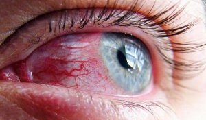 قرمزی و التهاب چشم در آکنه روزاسه چشمی با رگ‌های خونی برجسته