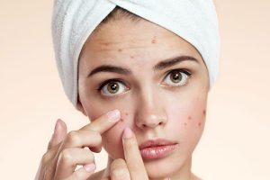 ایجاد اسکار و لکههای دائمی بر اثر فشار دادن جوشهای آکنه ولگاریس