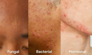 مقایسه آکنه قارچی، باکتریایی و هورمونی روی پوست برای تشخیص و درمان صحیح