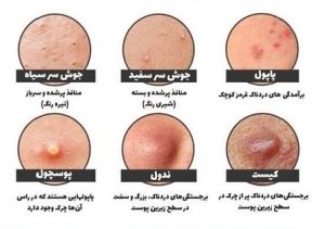 نمایش انواع جوشهای التهابی و غیرالتهابی در آکنه والگاریس شامل کومدونهای بسته و باز، پاپول و پوسچول، نودول و کیست روی پوست