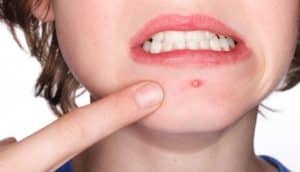 زنی که از جوش صورت خود ناراحت است