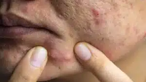 آکنه کیستیک التهابی روی صورت و هشدار دستکاری آن برای جلوگیری از لک و اسکار
